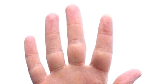 Finger Amputation Solicitors
